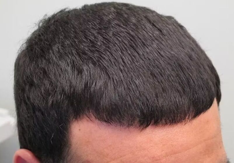 Ich habe Verdoxidil Haarausfall geheilt